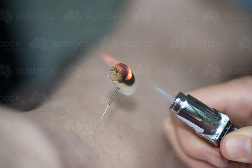 Acupuncture methods - Australian Stock Image