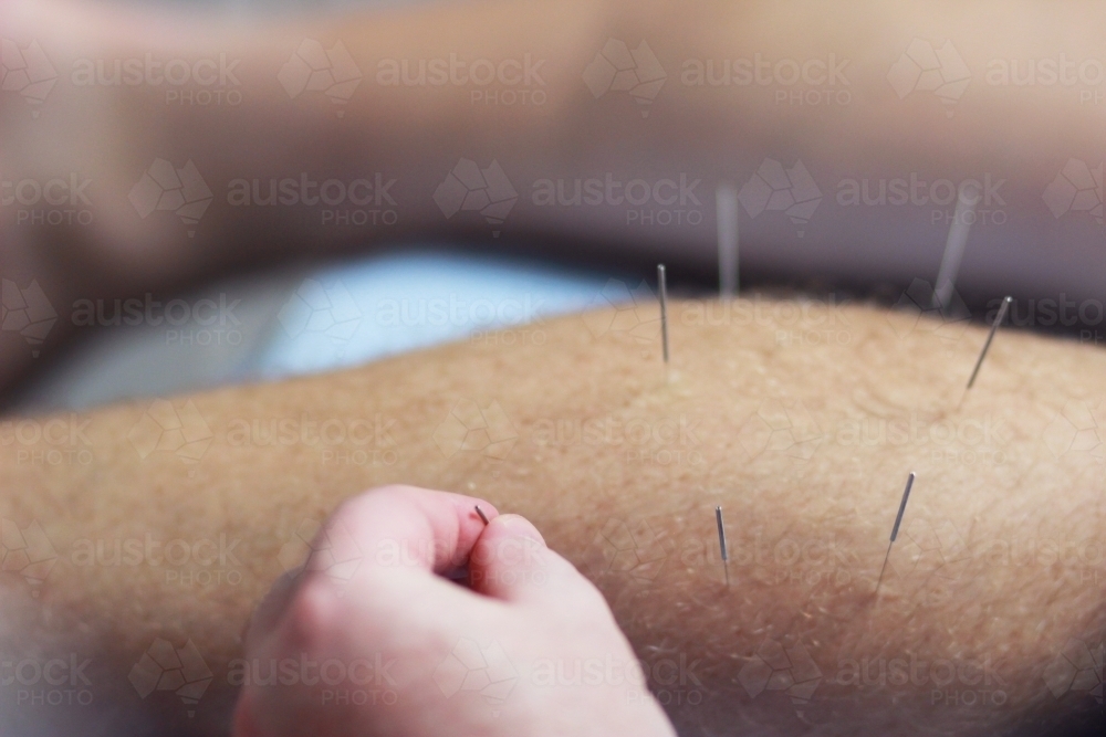 Acupuncture needles being put in a man's leg - Australian Stock Image