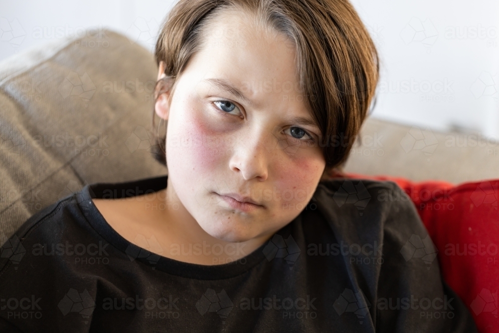 An unwell preteen boy lying on a couch looking at the camera, his cheeks are red from a fever - Australian Stock Image
