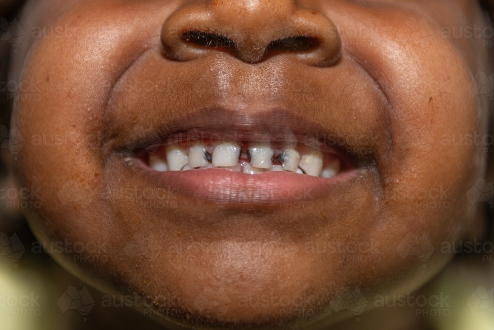 Child rotten teeth - Australian Stock Image
