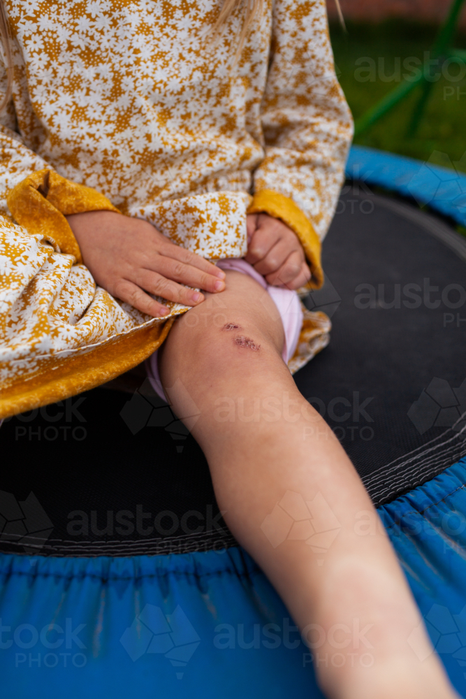 Child showing scab on her knee after falling over and hurting herself - Australian Stock Image