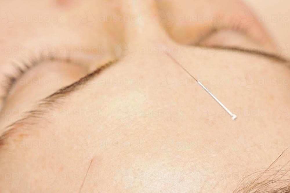 close up of acupuncture needle in a woman's forehead - Australian Stock Image