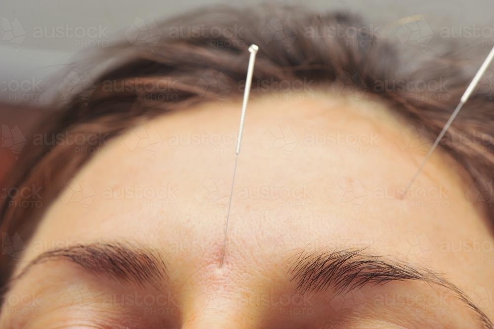 close up of acupuncture needle in a woman's forehead - Australian Stock Image