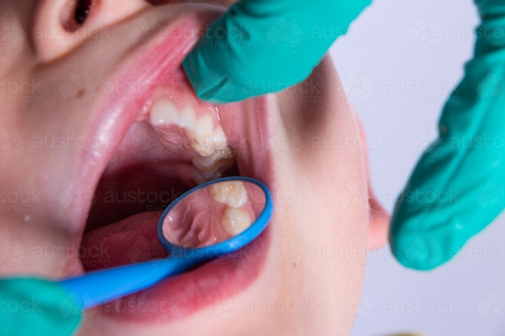 Dental mouth mirror checking child's teeth - Australian Stock Image