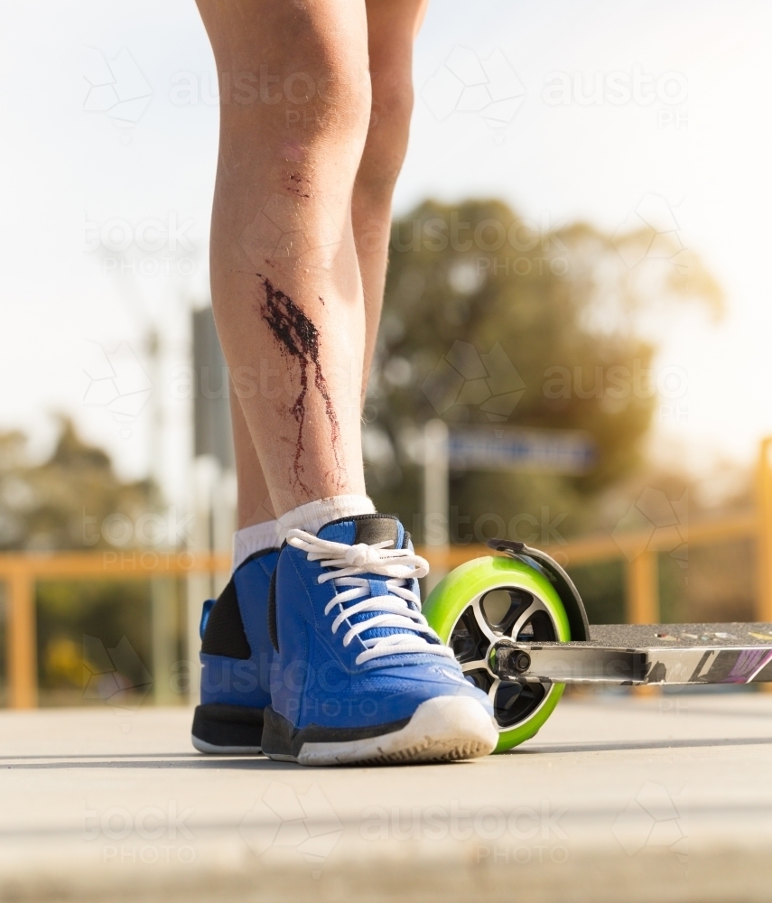 Dried blood on the shin of a kid with a scooter - Australian Stock Image