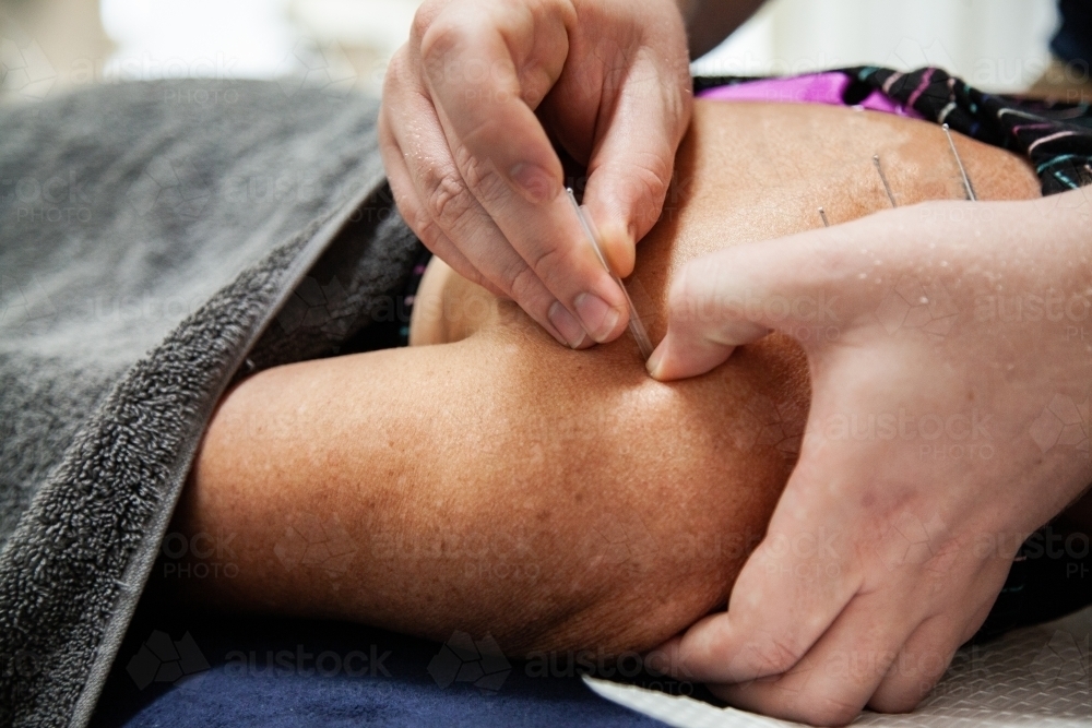 Dry needling for muscle relief - Australian Stock Image