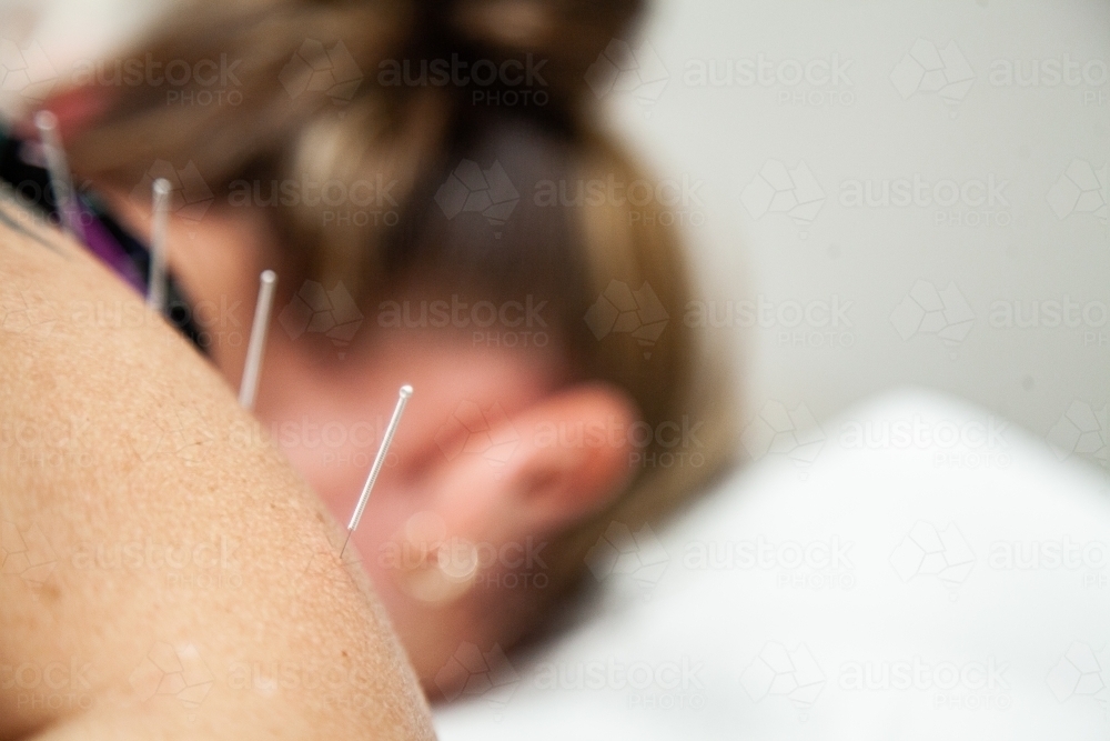 Dry needling for muscle relief - Australian Stock Image