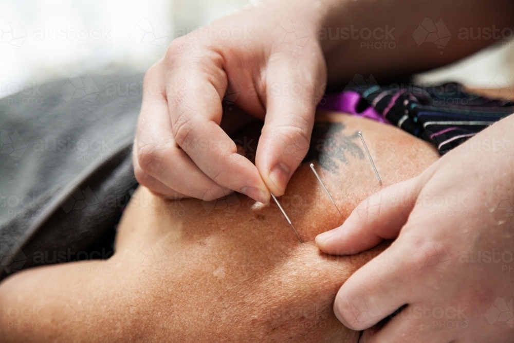 Dry needling in neck and shoulders - Australian Stock Image