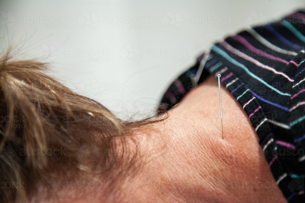 Dry needling in neck and shoulders - Australian Stock Image