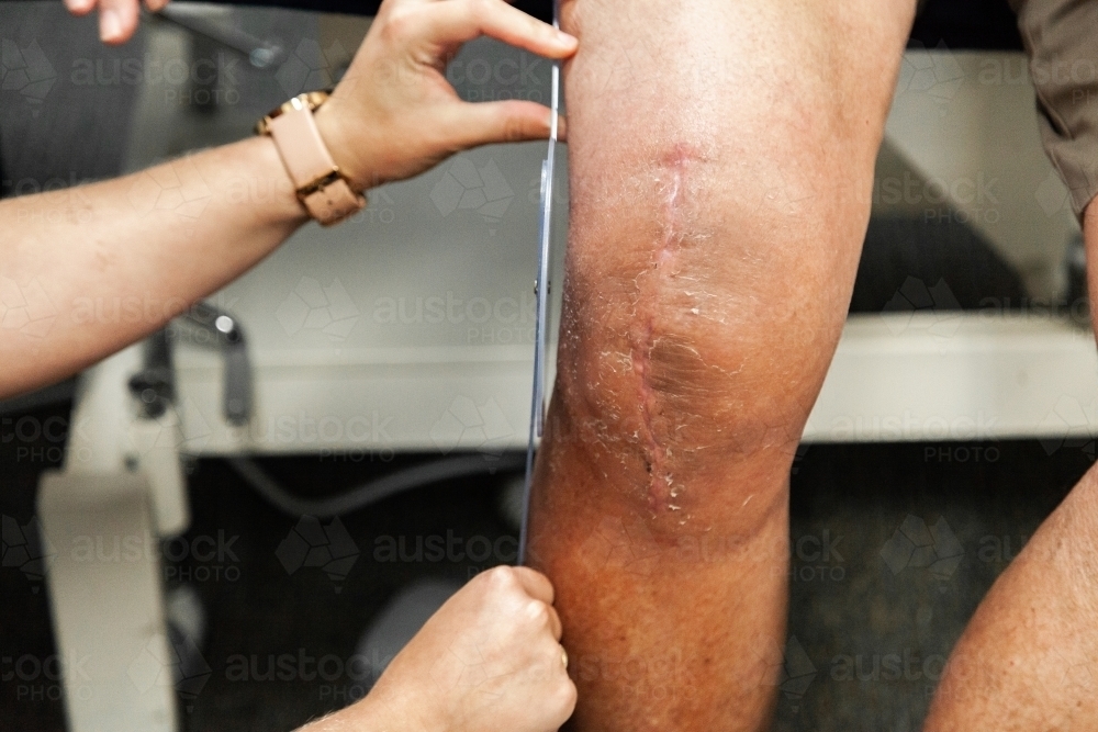 Physio measuring knee bend angle - Australian Stock Image