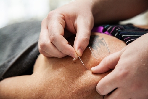 Dry needling in neck and shoulders