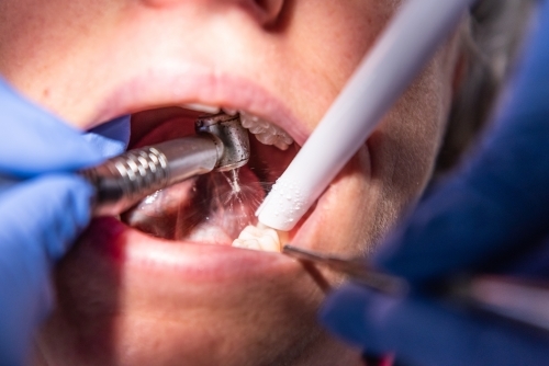 Lady having dental filling at dentist office - Australian Stock Image